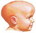 En los bebés, el signo más obvio de la Hidrocefalia es el rápido crecimiento de la circunferencia de la cabeza o una cabeza demasiado grande y las fontanelas se verán abombadas aún cuando el bebé este en posición vertical