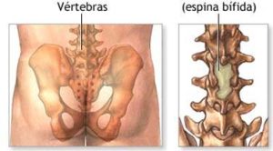 Espina Bífida: El nombre se deriva del latín y quiere decir “espina abierta”. Médicamente se refiere a un defecto al nacimiento en donde la espina o columna vertebral, no se forma completamente