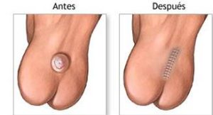 El bebé deberá permanecer en el hospital para vigilancia constante. La posición ideal durante los primeros días es boca abajo para evitar que la orina y las heces fecales contaminen la herida.