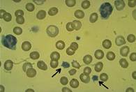 Síndrome de Bernard-Soulier de plaquetas gigantes: Trastorno familiar de la coagulación que se caracteriza por tiempo de sangrado prolongado, plaquetas inusualmente grandes y escasas y un consumo de protrombina alterado.