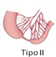 Tipo II