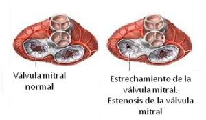 cardiopatia2