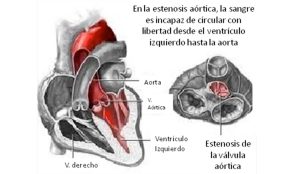 cardiopatia4