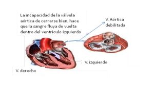 cardiopatia5