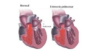 cardiopatia6
