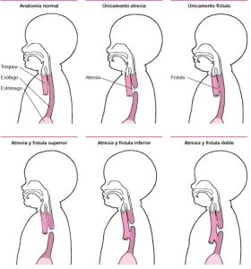 Atresia esofágica con fístula traqueoesofágica distal y proximal 