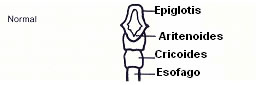 Tipo 0: en el que tan sólo existiría una hendidura alta limitada a las partes blandas (músculo interaritenoideo), sin afectación del cartílago cricoides.